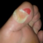 Blister